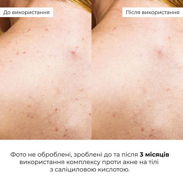 Комплект для боротьби з акне на тілі з саліциловою кислотою Hillary Salicylic Body Acne Treatment Set K2-11-093 фото